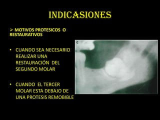 INDICASIONES
 MOTIVOS PROTESICOS O
RESTAURATIVOS


• CUANDO SEA NECESARIO
  REALIZAR UNA
  RESTAURACIÓN DEL
  SEGUNDO MOLAR

• CUANDO EL TERCER
  MOLAR ESTA DEBAJO DE
  UNA PROTESIS REMOBIBLE
 