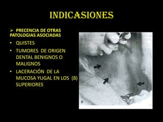 INDICASIONES
 PRECENCIA DE OTRAS
PATOLOGIAS ASOCIADAS
• QUISTES
• TUMORES DE ORIGEN
  DENTAL BENIGNOS O
  MALIGNOS
• LACERACIÓN DE LA
  MUCOSA YUGAL EN LOS (8)
  SUPERIORES
 
