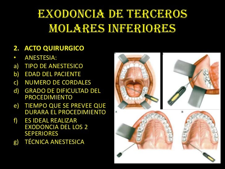 Protocolo De Cirugia De Terceros Molares