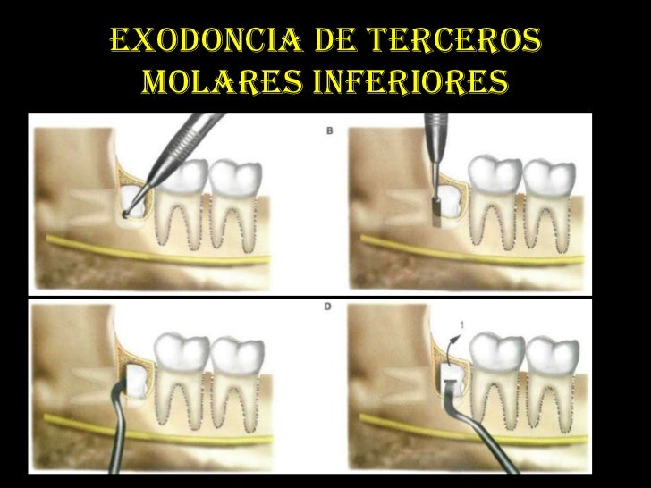 Cirugia De Terceros Molares