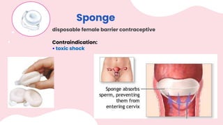 Sponge
disposable female barrier contraceptive
Contraindication:
• toxic shock
 