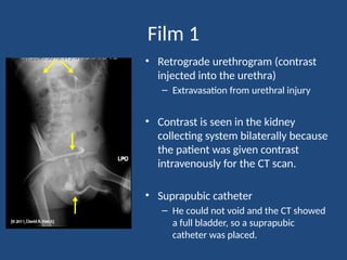 Trauma Urethrogram Comprehensive Uroradiology: Cystography, Urethrography & Trauma Imaging ...