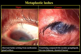 Metaplastic lashes
               Signs                                       Causes




Aberrant lashes arising from meibomian   Cicatrizing conjunctivitis (ocular pemphigoid,
gland orifices                           Stevens-Johnson, chemical burns)
 