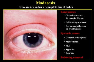Madarosis
Decrease in number or complete loss of lashes
                                  Local causes
                                     •   Chronic anterior
                                         lid margin disease
                                     •   Infiltrating tumours
                                     •   Burns, radiotherapy
                                         or cryotherapy

                                  Systemic causes
                                     •   Generalized alopecia
                                     •   Myxoedema
                                     •   SLE
                                     •   Syphilis
                                     •   Leprosy

                                  Following removal
 