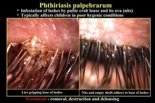 disorders of lashes | PPT