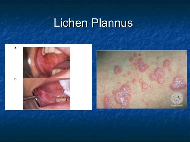 Extrahepatic Manifestations Of Hcv Extrahepatic Manifestations Of Hcv