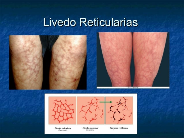 Extrahepatic Manifestations Of Hcv Extrahepatic Manifestations Of Hcv