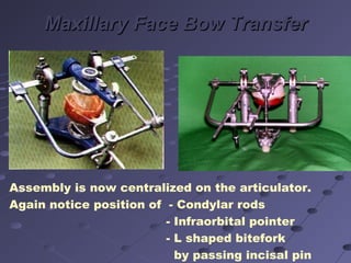 Condylar Rods 01 facebows and Articulators | PPT