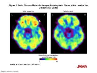 Figure 2. Brain Glucose Metabolic Images Showing Axial Planes at the Level of the
                                            Orbitofrontal Cortex




                Volkow, N. D. et al. JAMA 2011;305:808-813



Copyright restrictions may apply.
 