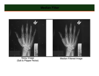 Median Filter




     Noisy Image                        Median Filtered Image
(Salt & Pepper Noise)
 