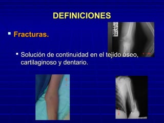 DEFINICIONESDEFINICIONES
 Fracturas.Fracturas.
 Solución de continuidad en el tejido óseo,Solución de continuidad en el tejido óseo,
cartilaginoso y dentario.cartilaginoso y dentario.
 