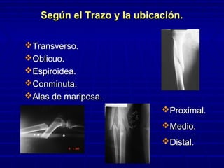 Según el Trazo y la ubicación.Según el Trazo y la ubicación.
Transverso.Transverso.
Oblicuo.Oblicuo.
Espiroidea.Espiroidea.
Conminuta.Conminuta.
Alas de mariposa.Alas de mariposa.
Proximal.Proximal.
Medio.Medio.
Distal.Distal.
 