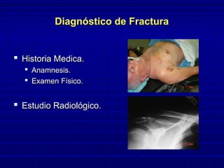 Diagnóstico de FracturaDiagnóstico de Fractura
 Historia Medica.Historia Medica.
 Anamnesis.Anamnesis.
 Examen Físico.Examen Físico.
 Estudio Radiológico.Estudio Radiológico.
 