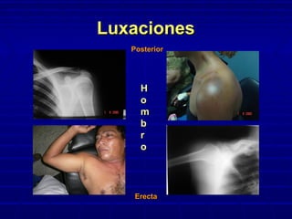 LuxacionesLuxaciones
HH
oo
mm
bb
rr
oo
ErectaErecta
PosteriorPosterior
 