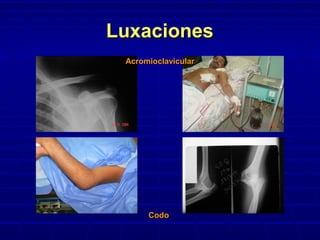 LuxacionesLuxaciones
CodoCodo
AcromioclavicularAcromioclavicular
 