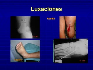 LuxacionesLuxaciones
RodillaRodilla
TobilloTobillo CuboidesCuboides
 