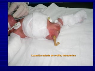 LuxacionesLuxaciones
Luxación abierta de rodilla, IntrauterinaLuxación abierta de rodilla, Intrauterina
 