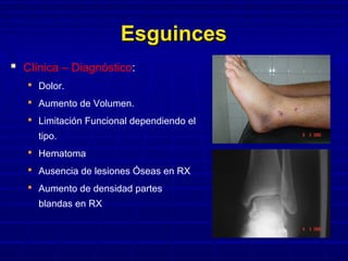 EsguincesEsguinces
 Clínica – Diagnóstico:
 Dolor.
 Aumento de Volumen.
 Limitación Funcional dependiendo el
tipo.
 Hematoma
 Ausencia de lesiones Óseas en RX
 Aumento de densidad partes
blandas en RX
 