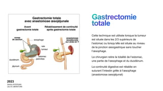 Cette technique est utilisée lorsque la tumeur
est située dans les 2/3 supérieurs de
l’estomac ou lorsqu’elle est située au niveau
de la jonction œsogastrique sans toucher
l’œsophage.
Le chirurgien retire la totalité de l’estomac,
une partie de l’œsophage et du duodénum.
La continuité digestive est rétablie en
suturant l’intestin grêle à l’œsophage
(anastomose oesojéjunal)
2023
Sebiha AYDOGAN
Léa DI LIBERATORE
 