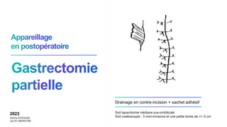 Drainage en contre-incision + sachet adhésif
2023
Sebiha AYDOGAN
Léa DI LIBERATORE
Soit laparotomie médiane sus-ombilicale
Soit coelioscopie : 3 mini-incisions et une petite tomie de +/- 5 cm
 