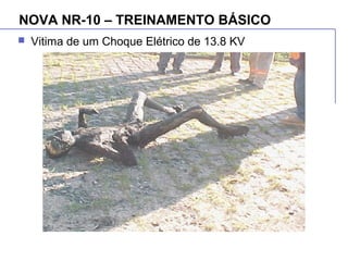 NOVA NR-10 – TREINAMENTO BÁSICO
 Vitima de um Choque Elétrico de 13.8 KV
 