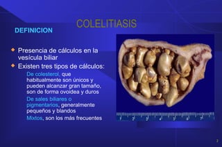 COLELITIASISDEFINICION
 Presencia de cálculos en la
vesícula biliar
 Existen tres tipos de cálculos:
De colesterol, que
...