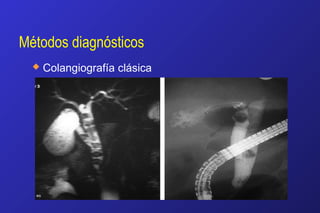Métodos diagnósticos
 Colangiografía clásica
 