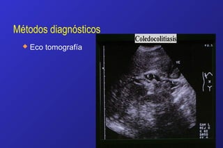 Métodos diagnósticos
 Eco tomografía
 