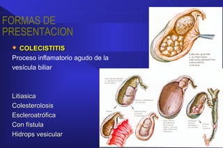 FORMAS DE
PRESENTACION
 COLECISTITISCOLECISTITIS
Proceso inflamatorio agudo de la
vesícula biliar
LitiasicaLitiasica
ColesterolosisColesterolosis
EscleroatróficaEscleroatrófica
Con fístulaCon fístula
Hidrops vesicularHidrops vesicular
 