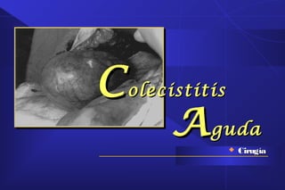 CColecistitisolecistitis
AAgudaguda
 CirugíaCirugía
 
