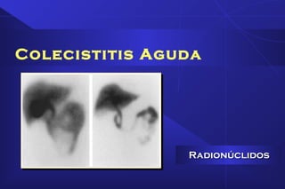 Colecistitis Aguda
RadionúclidosRadionúclidos
 
