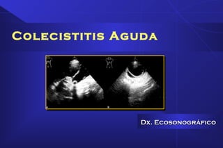 Colecistitis Aguda
Dx. EcosonográficoDx. Ecosonográfico
 