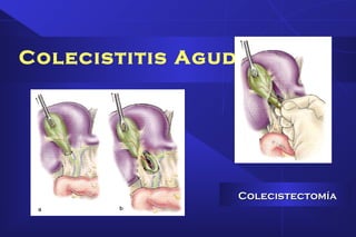 Colecistitis Aguda
ColecistectomíaColecistectomía
 