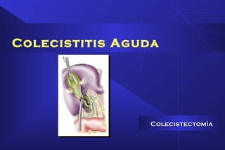Colecistitis Aguda
ColecistectomíaColecistectomía
 