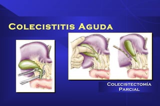 Colecistitis Aguda
ColecistectomíaColecistectomía
ParcialParcial
 
