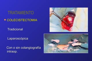 TRATAMIENTO
 COLECISTECTOMIACOLECISTECTOMIA
TradicionalTradicional
LaparoscópicaLaparoscópica
Con o sin colangiografíaCon o sin colangiografía
intraop.intraop.
 