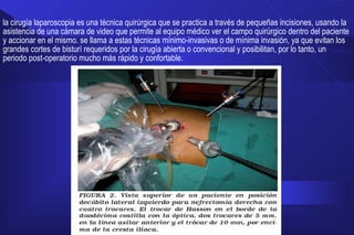 la cirugía laparoscopia es una técnica quirúrgica que se practica a través de pequeñas incisiones, usando la
asistencia de una cámara de video que permite al equipo médico ver el campo quirúrgico dentro del paciente
y accionar en el mismo. se llama a estas técnicas mínimo-invasivas o de mínima invasión, ya que evitan los
grandes cortes de bisturí requeridos por la cirugía abierta o convencional y posibilitan, por lo tanto, un
periodo post-operatorio mucho más rápido y confortable.
 