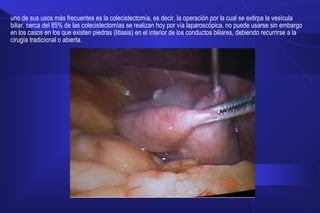 uno de sus usos más frecuentes es la colecistectomía, es decir, la operación por la cual se extirpa la vesícula
biliar. cerca del 85% de las colecistectomías se realizan hoy por vía laparoscópica. no puede usarse sin embargo
en los casos en los que existen piedras (litiasis) en el interior de los conductos biliares, debiendo recurrirse a la
cirugía tradicional o abierta.
 