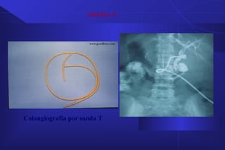 SONDA T
Colangiografía por sonda T
 