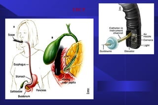 ERCP
 