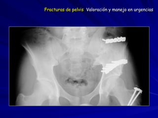 Fracturas de pelvis Valoración y manejo en urgencias
 