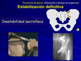 Estabilización definitiva
Inestabilidad sacroilíaca
Fracturas de pelvis Valoración y manejo en urgencias
 