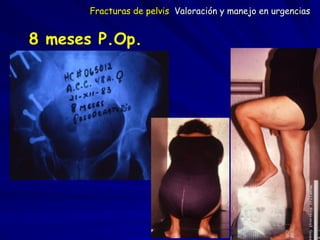 8 meses P.Op.
Fracturas de pelvis Valoración y manejo en urgencias
 