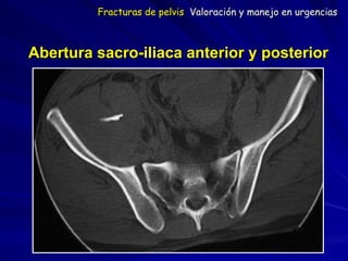 Abertura sacro-iliaca anterior y posterior
Fracturas de pelvis Valoración y manejo en urgencias
 
