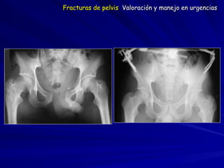 Fracturas de pelvis Valoración y manejo en urgencias
 