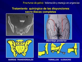 Tratamiento quirúrgico de las disyunciones  
sacro-iliacas completas
Abordaje posterior
BARRAS TRANSVERSALES TORNILLOS ILIOSACRO
Fracturas de pelvis Valoración y manejo en urgencias
 