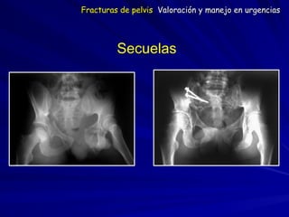 Secuelas
Fracturas de pelvis Valoración y manejo en urgencias
 