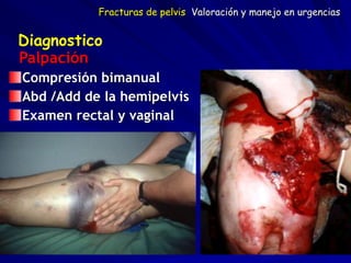 Palpación
Compresión bimanual
Abd /Add de la hemipelvis
Examen rectal y vaginal
Diagnostico
Fracturas de pelvis Valoración y manejo en urgencias
 