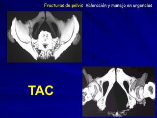 TAC
Fracturas de pelvis Valoración y manejo en urgencias
 