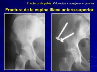 Fractura de la espina iliaca antero-superior
Fracturas de pelvis Valoración y manejo en urgencias
 